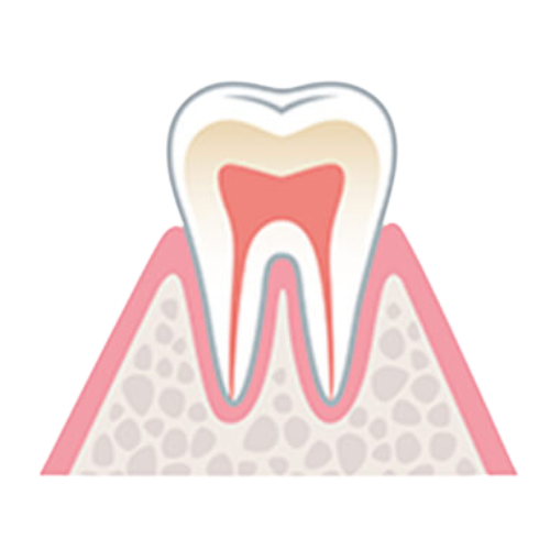 レミントン歯科歯肉炎
