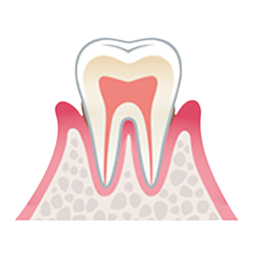 レミントン歯科歯周炎軽度