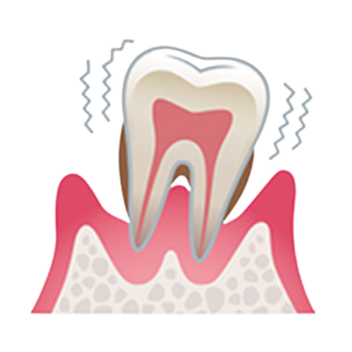 レミントン歯科歯周炎重度