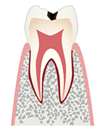 レミントン歯科虫歯治療エナメル質