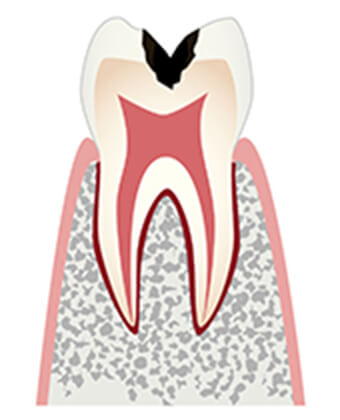 レミントン歯科虫歯治療象牙質