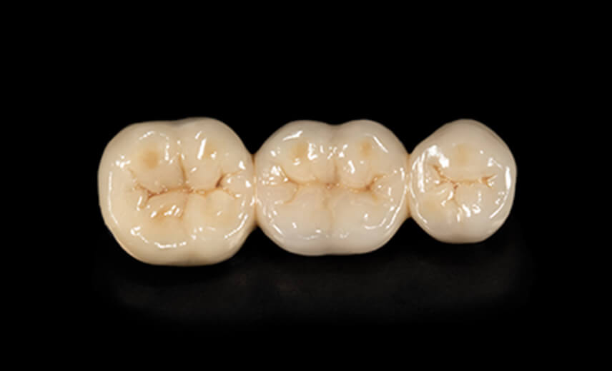 レミントン歯科審美歯科ハイブリッドセラミックス