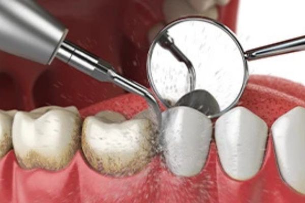 三鷹駅近くのレミントン歯科の診療案内歯周病