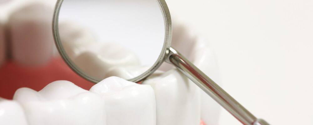 レミントン歯科予防治療