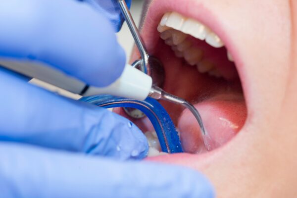 レミントン歯科歯石除去